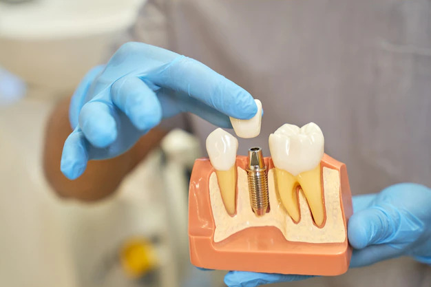 How Dental Implants Are Like Natural Teeth