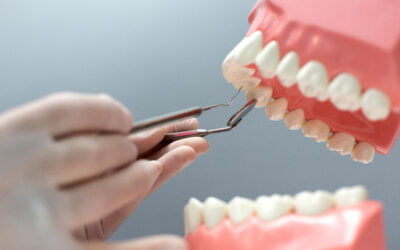 3 Types of Dental Implants – Which Is for You?