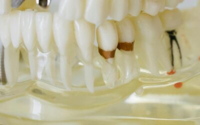 How to Maintain Your Dental Implants: Essential Tips for Longevity