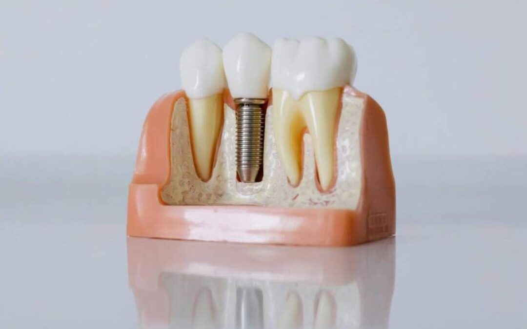 Common Myths About Dental Implants Debunked