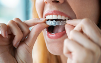 Can You Safely Get a Cavity Filled While Wearing Clear Aligners?