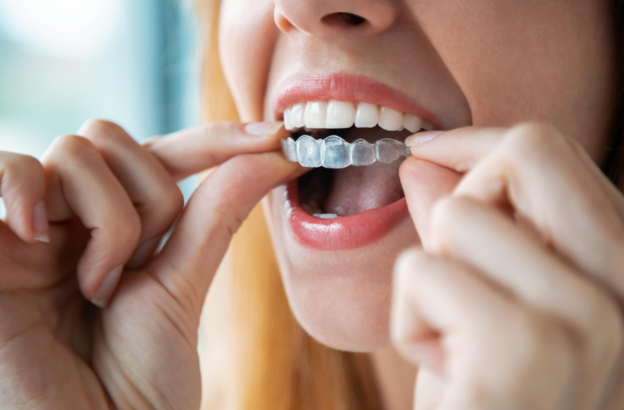 Can You Safely Get a Cavity Filled While Wearing Clear Aligners?