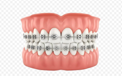 Why Do Adult Teeth Relapse Years After Wearing Traditional Braces?